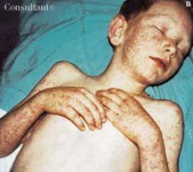 Maculopapular rash in Rocky Mountain spotted fever