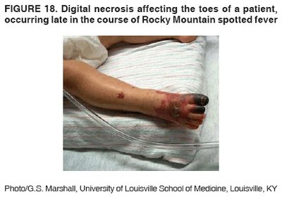 Digital necrosis in late-stage Rocky Mountain spotted fever
