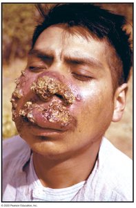 Cutaneous leishmaniasis clinical presentation