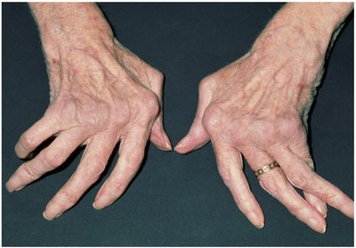 Crippling Distortion of Joints in Rheumatoid Arthritis