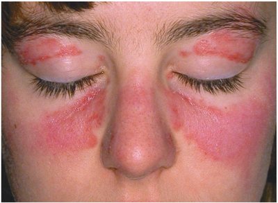 Facial Rash of Systemic Lupus Erythematosus