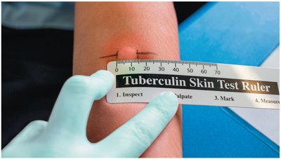 Positive Tuberculin Test (Type IV Hypersensitivity)