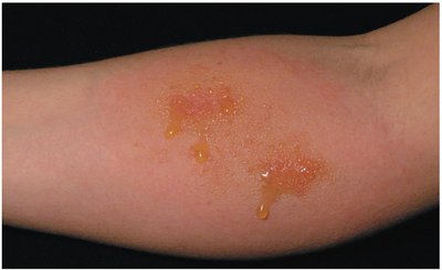 Allergic Contact Dermatitis (Type IV Hypersensitivity)