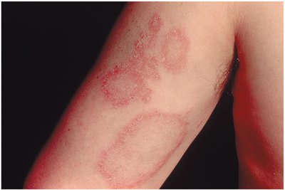 Urticaria (hives)