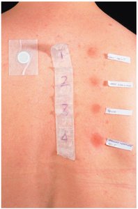 Skin Tests for Diagnosing Type I Hypersensitivity