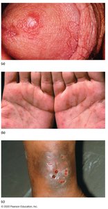 Clinical images of syphilis lesions