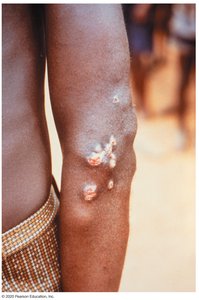 Skin lesions caused by yaws