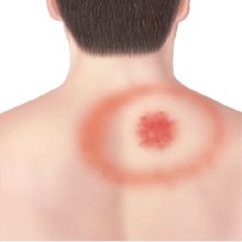 Bull's-eye rash characteristic of Lyme disease