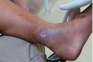Ulcer on leg