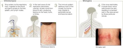 Chickenpox and shingles progression diagram