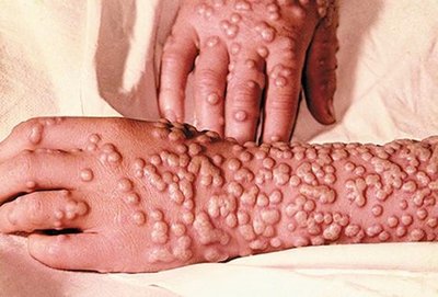 Smallpox rash on hands and arms
