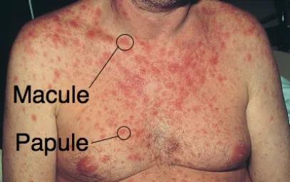 Maculopapular rash example