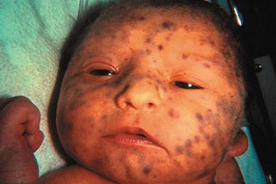 Congenital rubella syndrome (purpura)