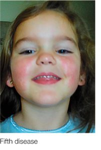 Fifth disease (slapped cheek rash)