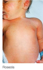 Roseola rash