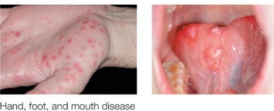 Hand, foot, and mouth disease (rash and oral lesions)