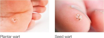 Plantar and seed warts