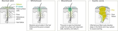 Acne progression (normal skin, whitehead, blackhead, cystic acne)