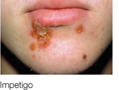 Impetigo (honey-colored crust)