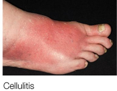 Cellulitis (red, swollen foot)