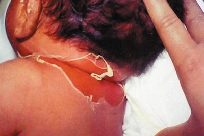 Scalded skin syndrome (peeling skin)