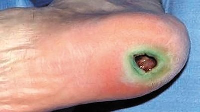 Pseudomonas wound infection (green pigment)