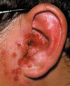 Otitis externa (swimmer's ear)