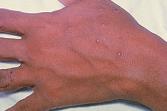 Vesicular rash on hand