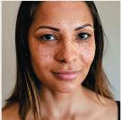 Macule (freckles) on face