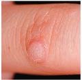 Papule on finger