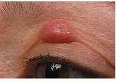 Pustule (acne)