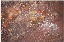Crust (impetigo)