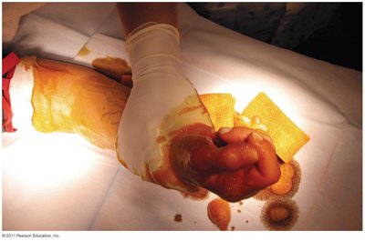 Degerming in preparation for surgery on a hand