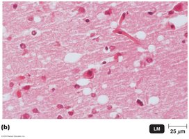 Spongiform encephalopathies: holes in brain tissue