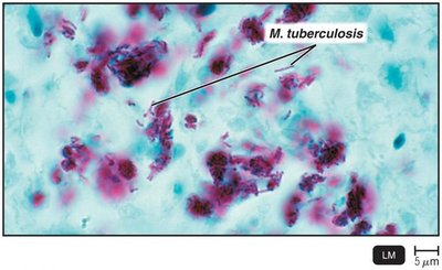 Acid-fast stain of Mycobacterium tuberculosis