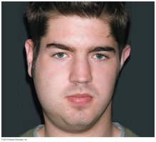 Bilateral parotid and submandibular gland enlargement in mumps