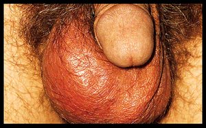 Mumps orchitis, a complication of mumps in adult males