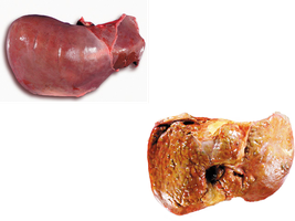 Healthy and diseased livers (hepatitis)