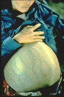 Ascites due to chronic hepatitis