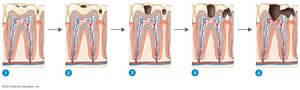Stages of tooth decay from healthy tooth to advanced decay