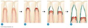 Stages of periodontal disease from healthy gums to periodontitis