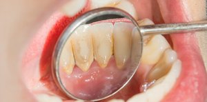 Dental plaque biofilm on teeth