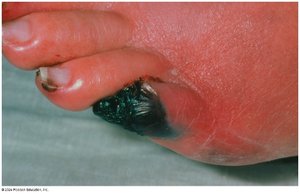 Gas gangrene caused by Clostridium
