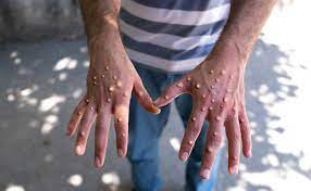 Monkeypox lesions on hands