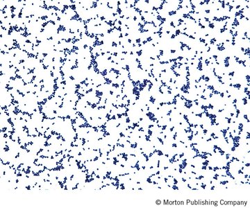 Gram-stained Staphylococcus aureus showing clusters of cocci