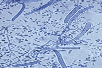 Plasmodium ring forms in red blood cells
