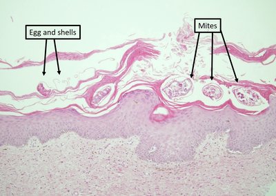 Histological section showing Sarcoptes scabiei mites and eggs in skin