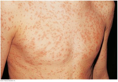 The rash of rubella