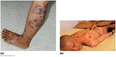 Diseases associated with AIDS