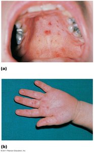 Lesions characteristic of hand-foot-and-mouth disease
